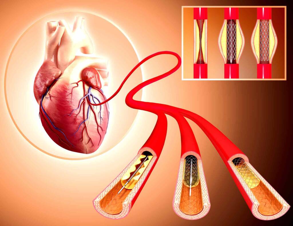 Angiography and Angioplasty